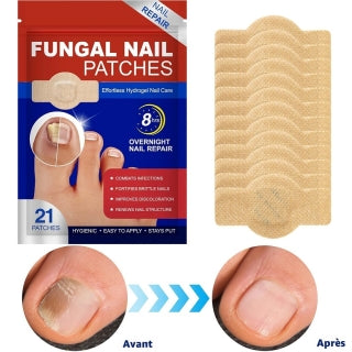 FUNGAL NAIL PATCHES