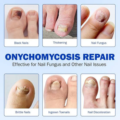 FUNGAL NAIL PATCHES