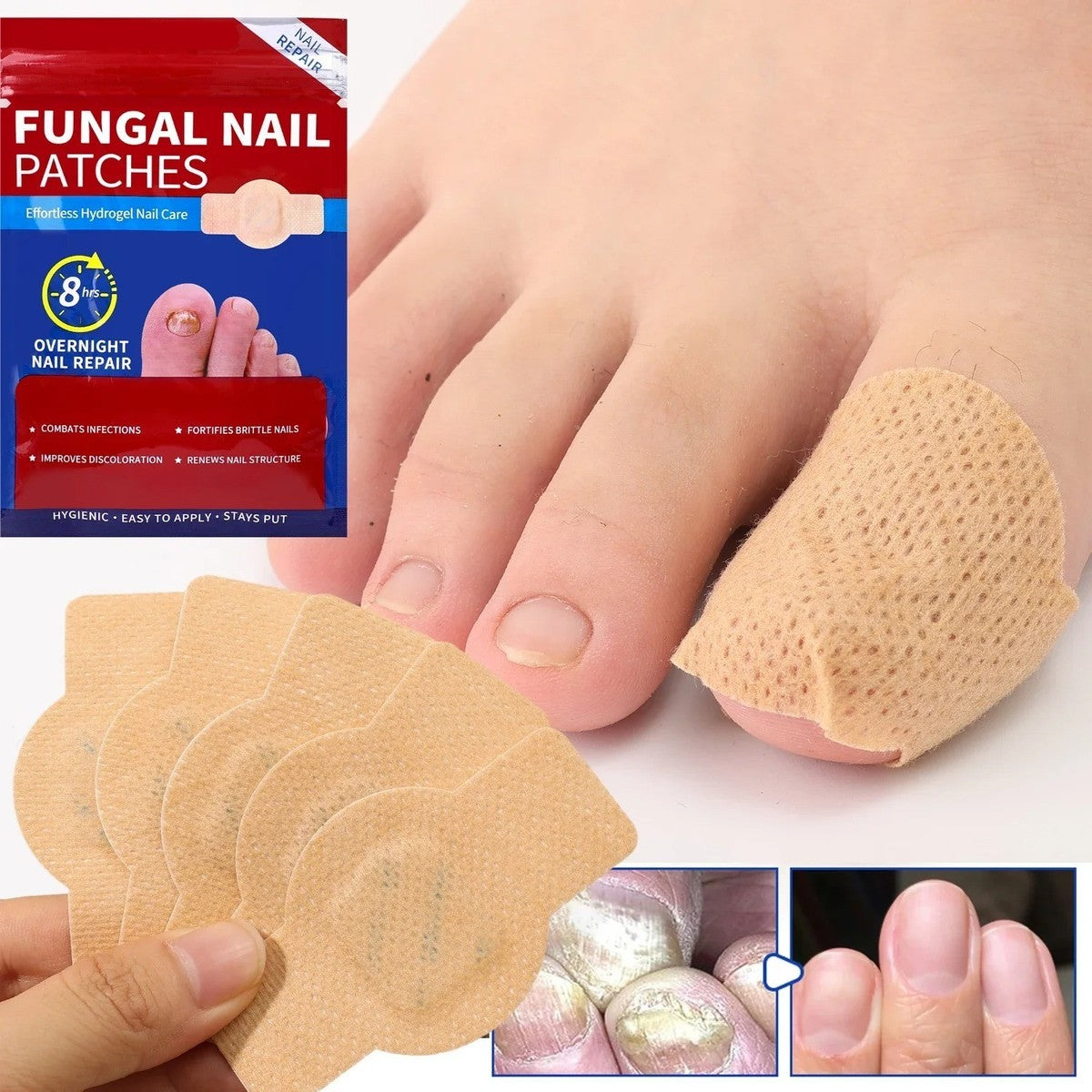 FUNGAL NAIL PATCHES